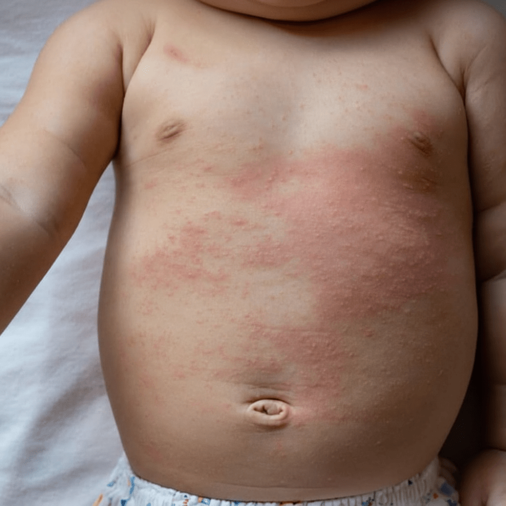 Baby skin showing irritation that may be soothed with gentler, filtered bath water
