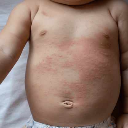Baby skin showing irritation that may be soothed with gentler, filtered bath water